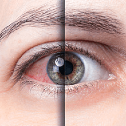 Prevenzione della secchezza negli occhi